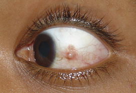 olhos com lesões por espículas - 2